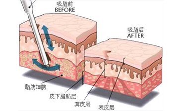 廣州吸脂瘦臉要多少錢