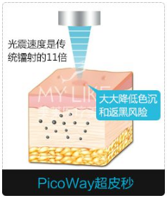 深圳超皮秒激光祛斑做幾次好