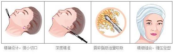 面部吸脂術后臉部出現(xiàn)的硬塊怎么消除呢