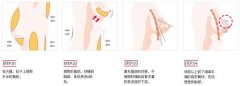 廣州做自體脂肪隆胸術后會不會出現(xiàn)胸部下垂的現(xiàn)象呢