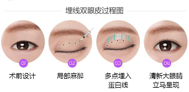 埋線雙眼皮術(shù)后多長時間恢復正常