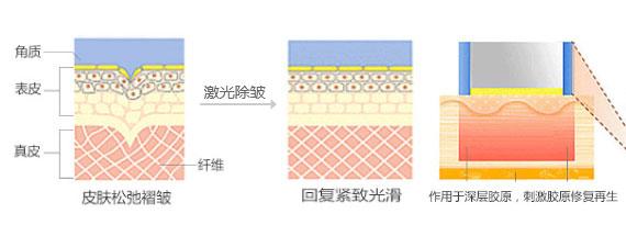 西安面部除皺失敗了怎么修復(fù)