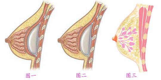 蘇州自體脂肪隆胸會(huì)有風(fēng)險(xiǎn)嗎