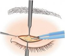 廣州上瞼下垂矯正需要多少錢呢