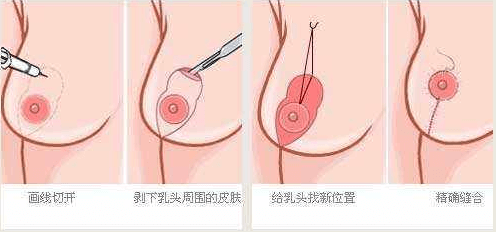 乳房下垂有些嚴重應該怎么辦