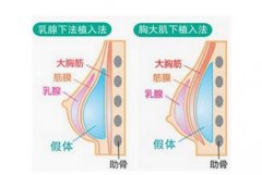 寧波假體隆胸效果怎么樣