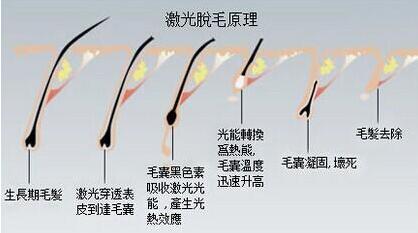 廈門(mén)激光脫毛幾次效果能持久