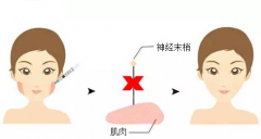 成都打瘦臉針的效果能夠維持多長時間