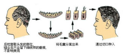 成都植發(fā)