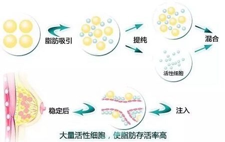 自體豐胸手術(shù)價格