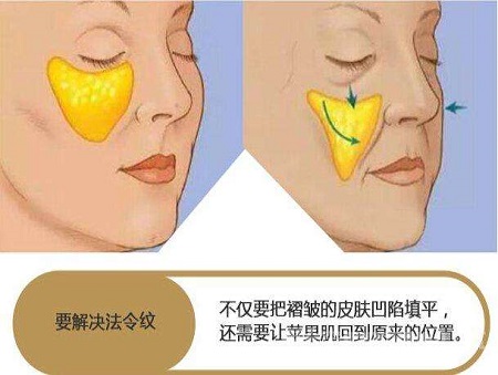 脂肪填充法令紋能維持多少時間？