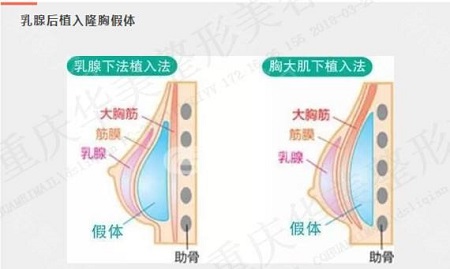 假體豐胸失敗修復(fù)價(jià)格