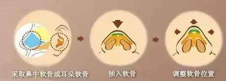 自體軟骨隆鼻的潛在風(fēng)險(xiǎn)