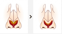 成都做韓式假體隆鼻手術有沒有風險