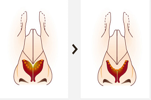 自體軟骨組織隆鼻有哪些優(yōu)點？