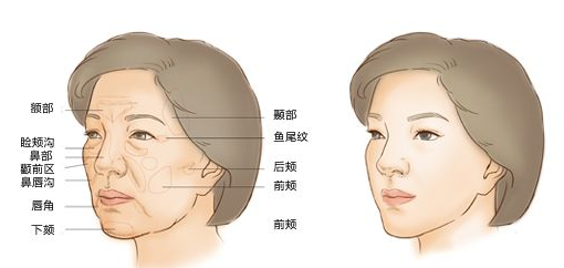 玻尿酸填充