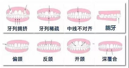 帶你一分鐘走出牙齒矯正誤區(qū)