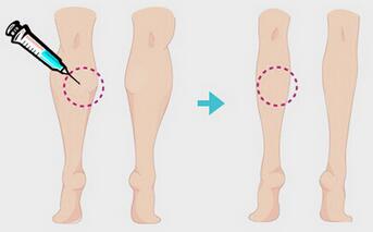 一針瘦腿多少錢？