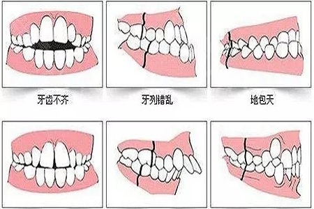 牙齒矯正的優(yōu)點(diǎn)是什么