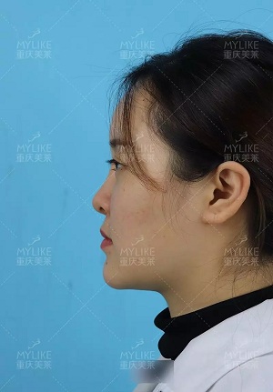 “鼻綜合”后假又歪，還攣縮？鼻修復(fù)還原自然生態(tài)美鼻