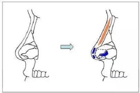 擔(dān)心鼻整形假體透光、發(fā)紅、移位？了解下自體軟骨