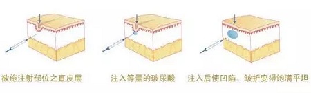 法令紋、川字紋