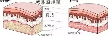 醫(yī)美白皮書：吸脂等于減肥嗎？