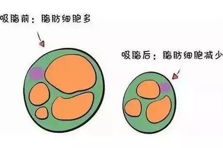 關(guān)于吸脂那些不能說的秘密，今天要在這里一次說完！