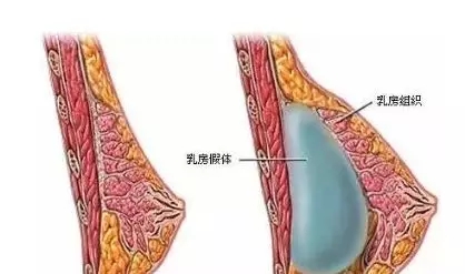 自體脂肪or假體隆胸，我到底應(yīng)該怎么選？