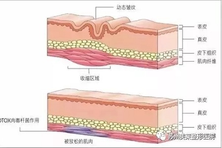 你無(wú)法用玻尿酸除掉所有皺紋！