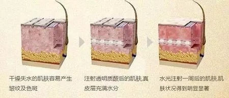 水光，打1次和4次究竟有多大區(qū)別？