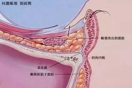 顯老淚溝，你還要任其放肆嗎？