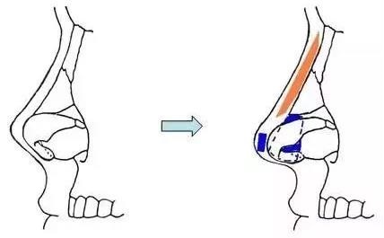 耳軟骨隆鼻過(guò)程圖