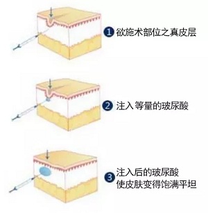 用玻尿酸治療鼻唇溝，一定要注意這種情況！