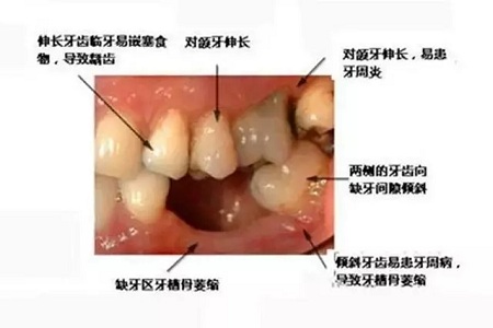 牙齒缺失時，選烤瓷牙還是那種？