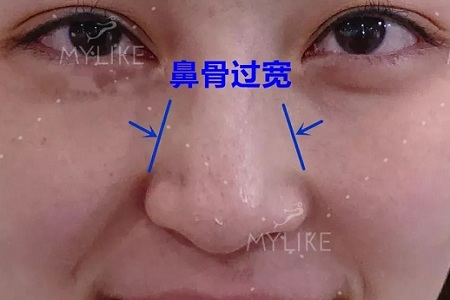 側(cè)面看鼻梁不矮,正面看鼻子卻很塌是什么原因？