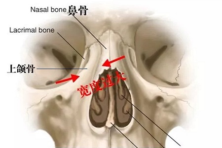 側(cè)面看鼻梁不矮,正面看鼻子卻很塌是什么原因？