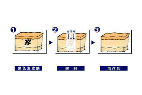 祛雀斑