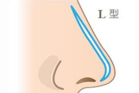 假體隆鼻失敗修復(fù)需要花費(fèi)多少錢