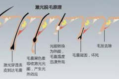 蘇州脫毛醫(yī)院做冰點脫毛的價格多少，對身體有沒有傷害