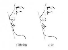 怎樣判斷下巴是否短縮，重慶整形醫(yī)院做矯正手術多少錢