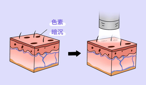 想要嫩膚，應(yīng)該選擇做光電還是水光